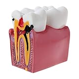 6-faches Zahnkaries Vergleichs Anatomie Zahnmodell Für Anatomie Lab