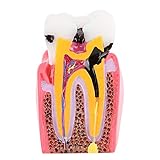 Kariesvergleich Studienmodelle Zahnarzt Zahnanatomie Ausbildung Zahnmodell Mundhygiene & Vorsorg